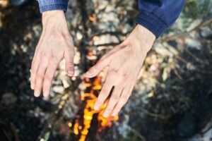 rodzaje-i-stopnie-oparzen-charakterystyka-oraz-zagrozenia-dla-zycia